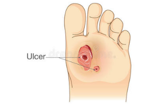儲(chǔ)存干細(xì)胞